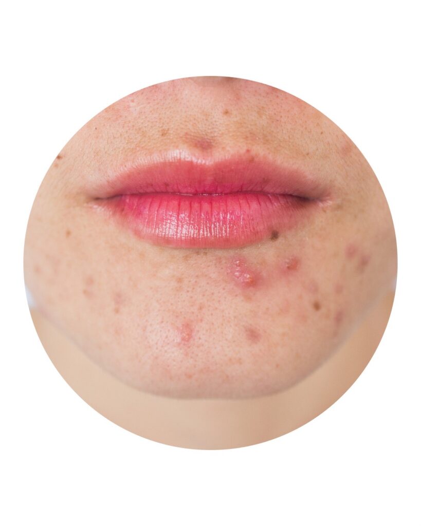 pimples